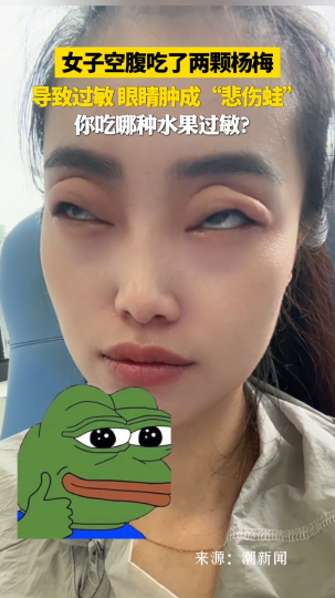 女子空腹吃了两颗杨梅导致过敏，眼睛肿成“悲伤蛙”