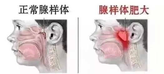 【腺样体肥大】别让无声的呼吸，偷走孩子的未来