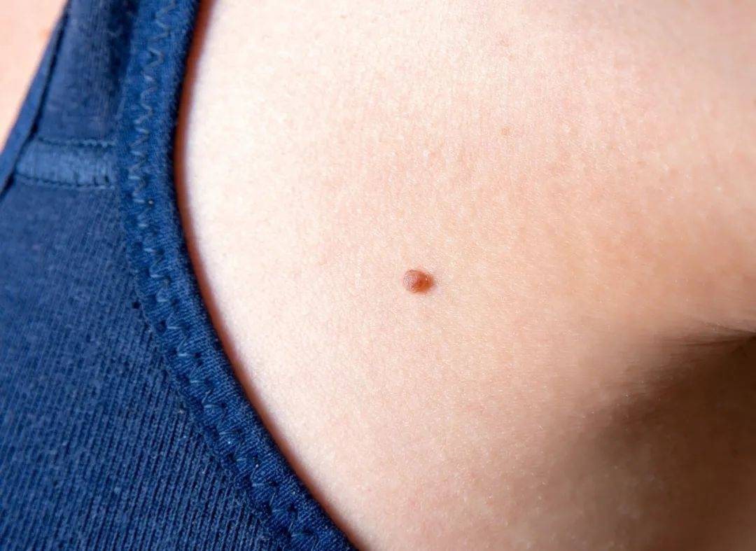 痣也可能癌变？长在这些地方要注意！医生提醒&rarr;