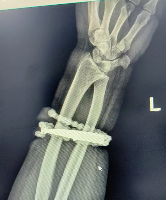 女子手镯10年没摘竟&ldquo;长&rdquo;进肉里！医生：再晚点就保不住了