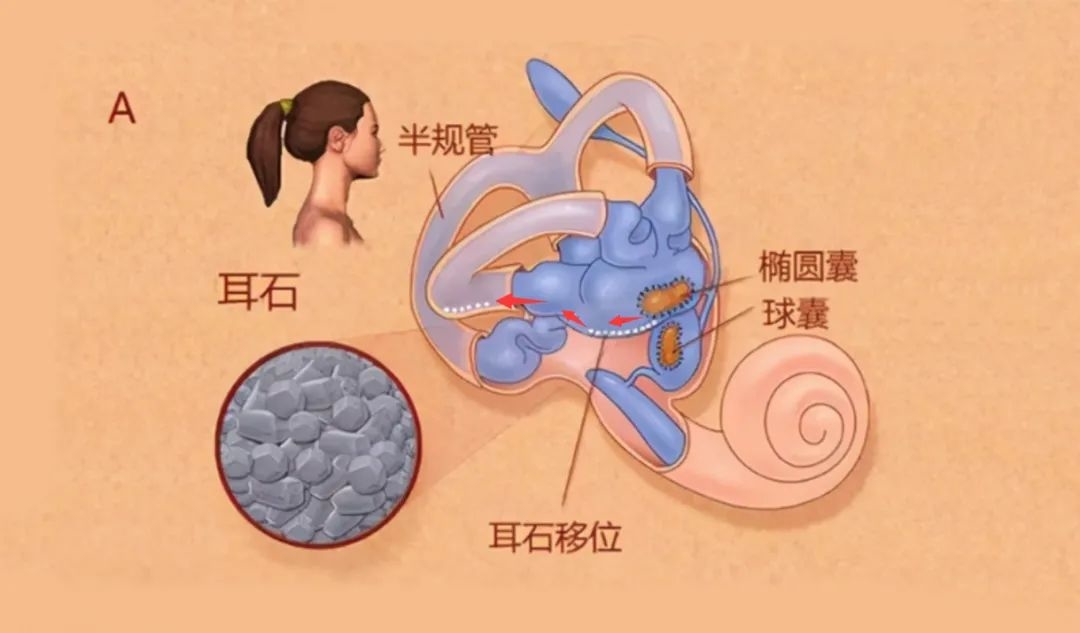 耳石症是怎么造成的图片